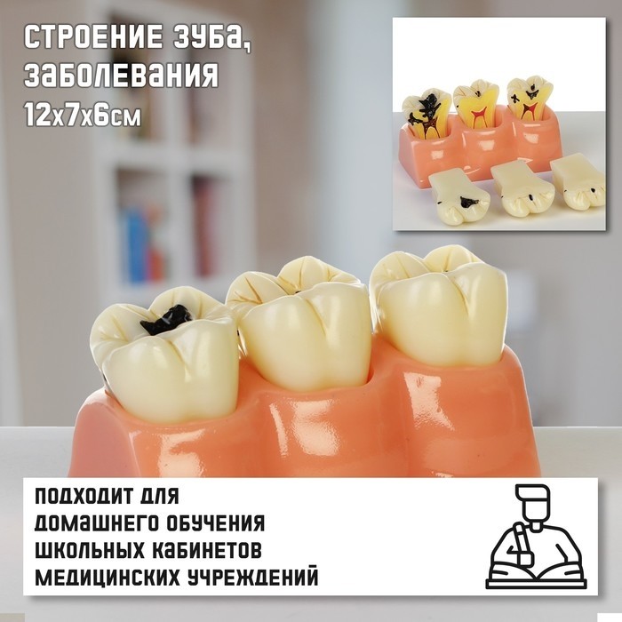 Анатомическая модель «Макет зуба с патологиями», 12×7×6 см